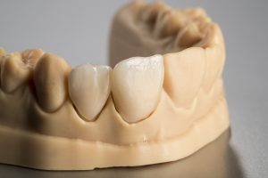 Tooth - Dental restoration